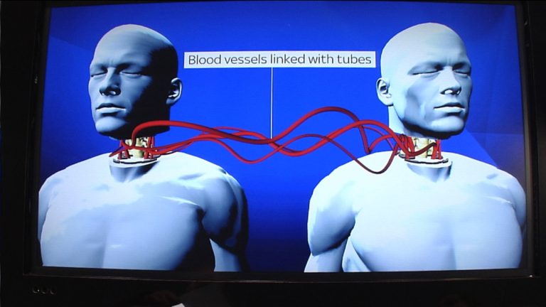 Head Transplant Doc Successfully Tests Procedure With Corpse